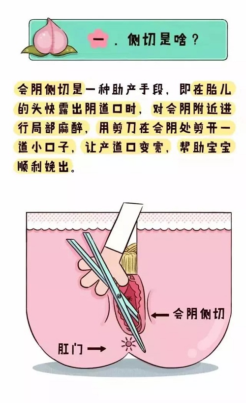 顺产侧切什么意思？顺产侧切多久可以同房？