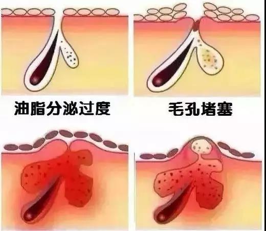 水油不平衡有几种表现？ 调节水油平衡真的很难？