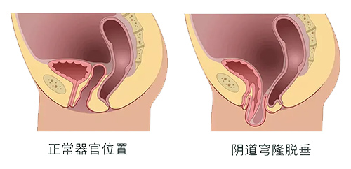 产后下面松弛是怎么回事？怎样调理呢？